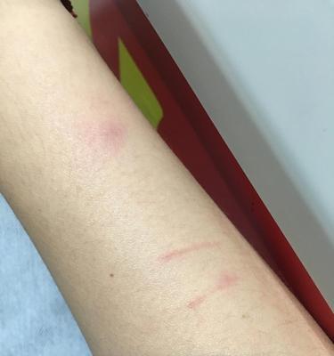 自家猫抓伤注射疫苗，怎么办？（宠物抓伤后的应对方法及防范措施）