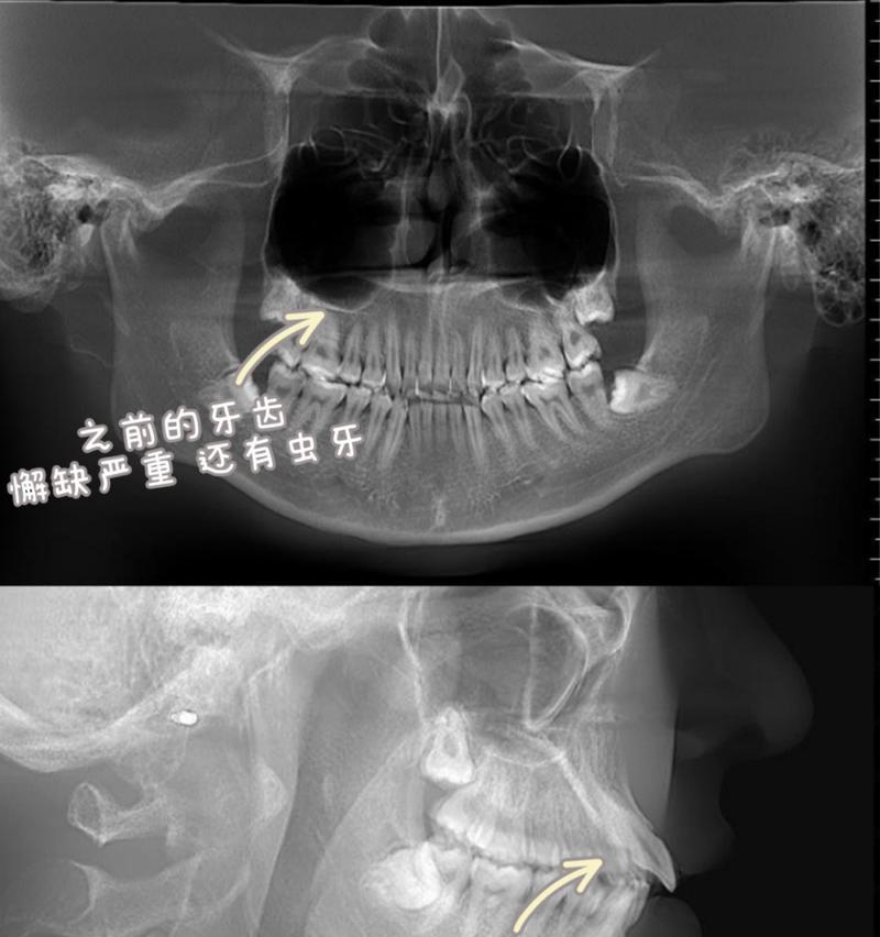 门齿不平矫正（寻找最佳治疗时机，让您笑容更自信）