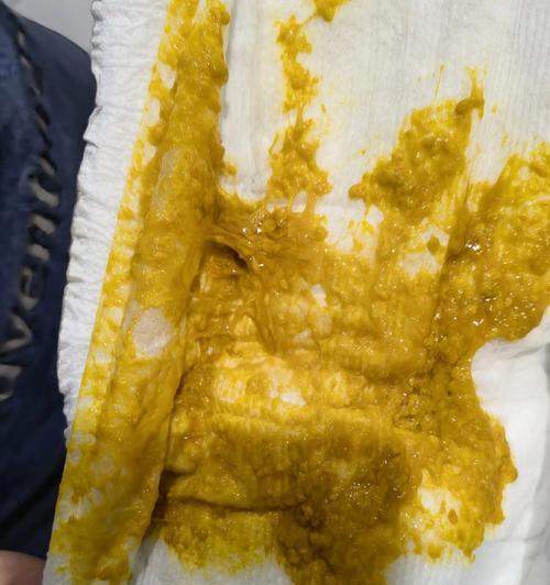 大便变黄的原因及健康建议（了解大便颜色变化的重要性及可能的原因）