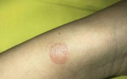 猫得了钱癣，你需要了解的症状与治疗（探索钱癣在猫身上的特征和预防方法）
