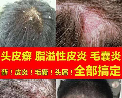 解决狗狗脂溢皮炎的药物及注意事项（科学选择药物，细心呵护宠物健康）