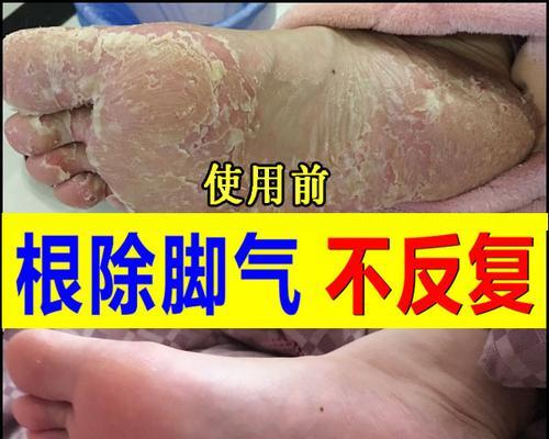 如何选择最适合萨摩去螨虫的药物？（探寻萨摩犬治疗螨虫的最佳药物及使用方法）