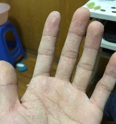 猫咪手掌脱皮的原因及处理方法（揭开猫咪手掌脱皮的神秘面纱，让爱宠健康快乐）