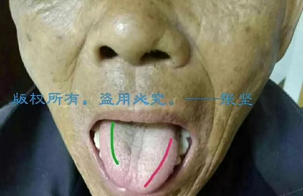 食道刮伤的症状及预防方法（了解食道刮伤，保护消化道健康）