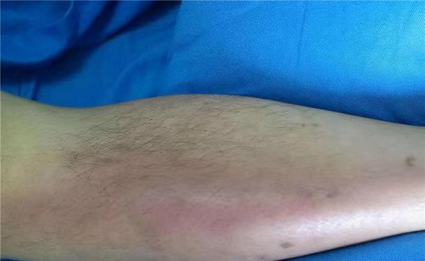狗血栓的症状及预防方法（了解狗血栓和保护你的宠物健康）
